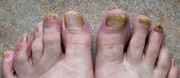 Antifungal Foot Care Serum- New- https://tinyurl.com/fhtdc8w